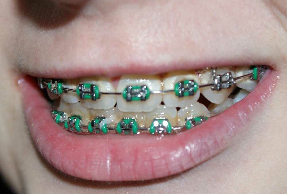 Braces – Vallejo Family Dentistry