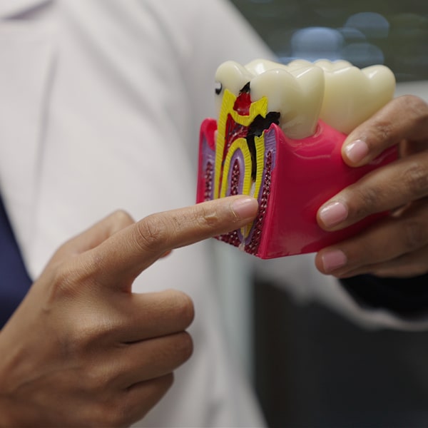 Model of dental implants with a finger pointing to the middle of it