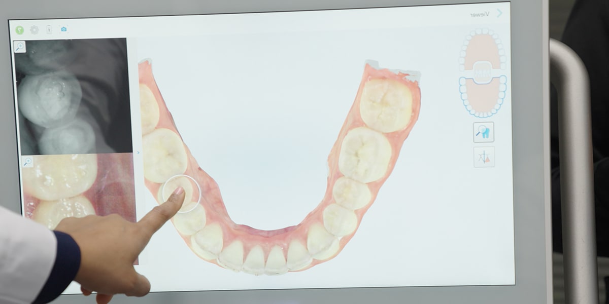 iTero scanner screen with a dental model