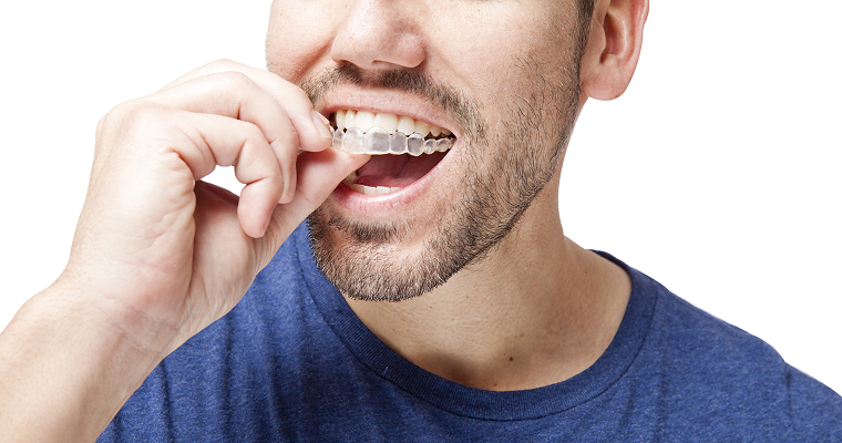 Vallejo Family Dentistry clear aligner Invisalign tray for discreet orthodontic treatment in Vallejo, CA